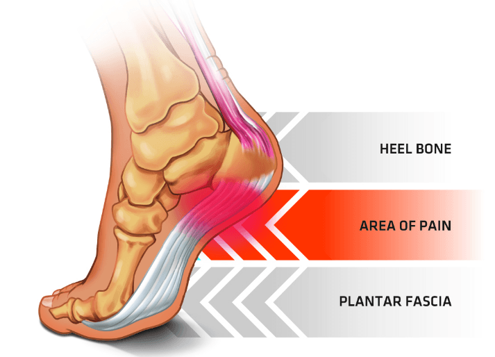 Orthotics for heel spurs and hot sale plantar fasciitis