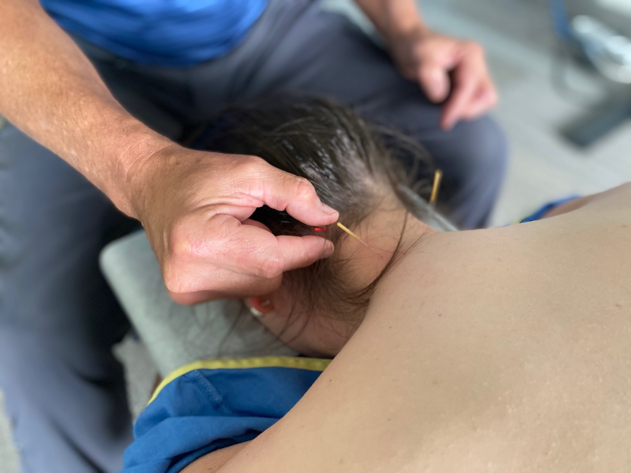 Dry Needling on the neck of a patient to relieve muscle tension and muscle spasms