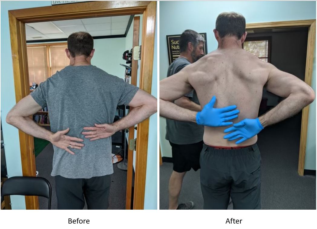 Dry Needling on Shoulder Before and After
