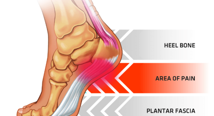 Main Causes of Back of Heel Pain in North Seattle | Foot and Ankle Center  of Lake City