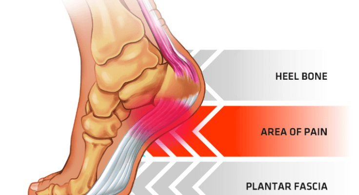 Custom Orthotics Can Help Relieve Plantar Fasciitis Northern Nevada 