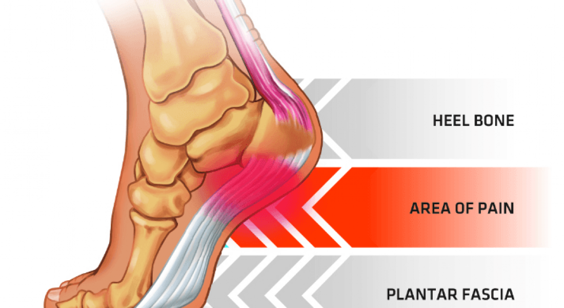 What’s the Difference Between Plantar Fasciitis and Heel Spurs